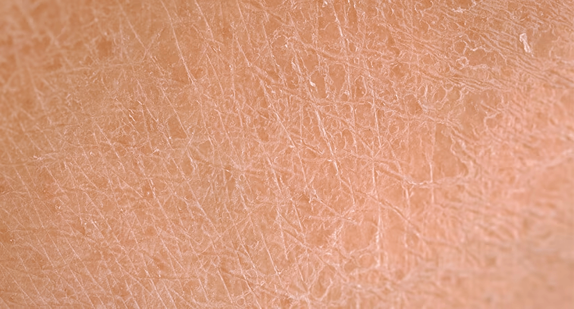 Très gros plan sur une peau humaine visiblement sèche et squameuse, montrant des craquelures et une texture rugueuse.