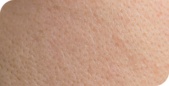Très gros plan sur une peau humaine, montrant en détail la texture des pores dilatés, caractéristique d'une peau grasse.